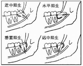 孕妇牙痛的原因有哪些